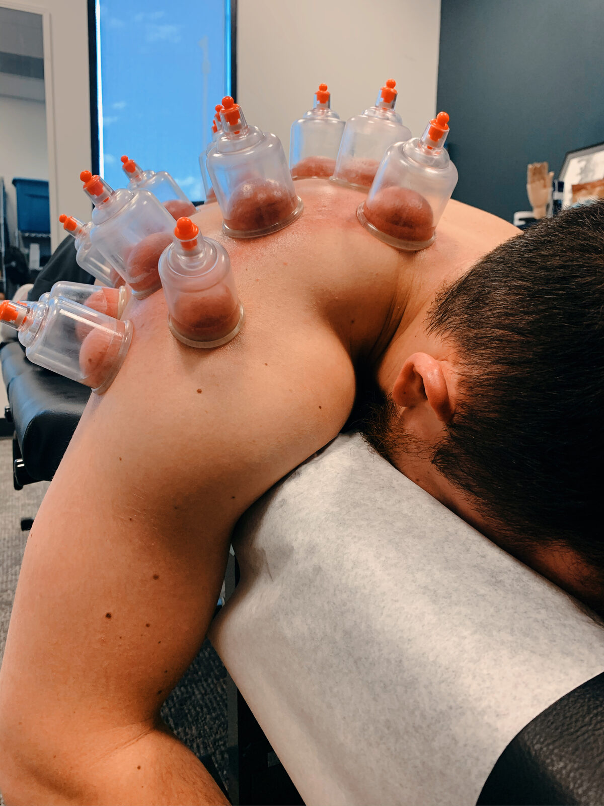 Cupping therapy for sports rehabilitation at WholeCare Marietta